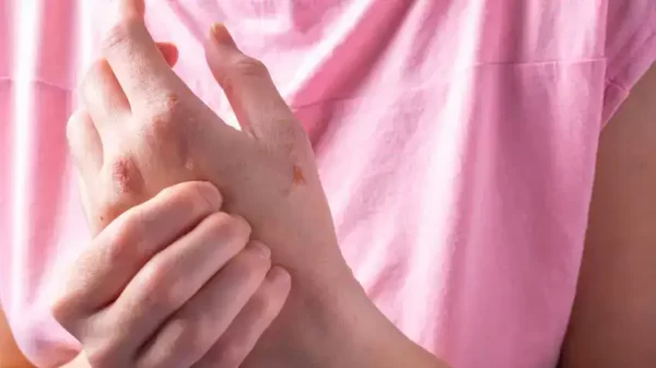 food sensitivities, eczema, skin conditions